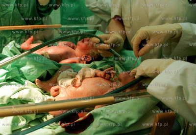 Gdanskie czworaczki Patryk i Michal na sali operacyjnej...